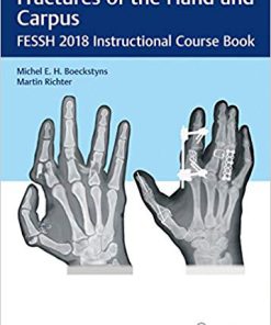 (eBook PDF) Fractures of the Hand and Carpus: FESSH 2018 Instructional Course Book